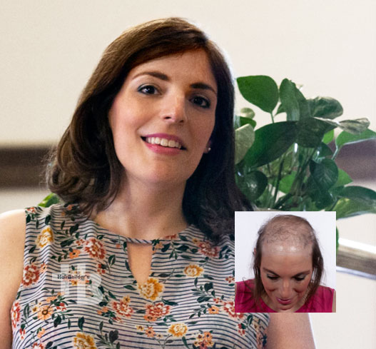 Womens hair loss replacement restoration burlington vermont
